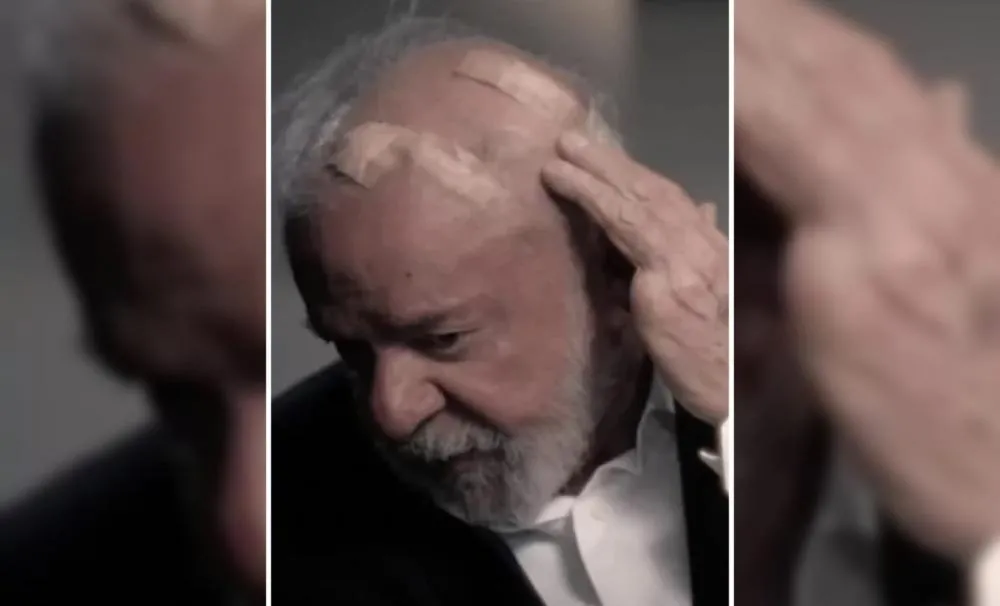 Lula exibe curativos após cirurgias de emergência e rompe mistério sobre sua saúde