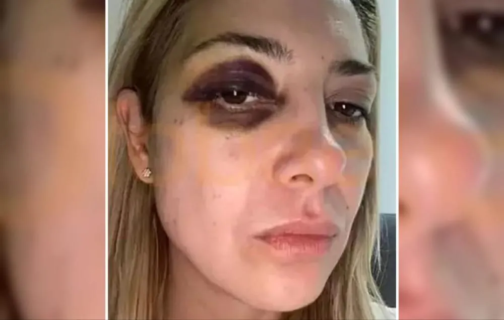 "Você me bate há 3 dias": diz ex-primeira dama argentina com o rosto cheio de hematomas