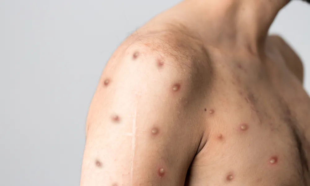 Mpox pode ser reclassificada como emergência global pela OMS