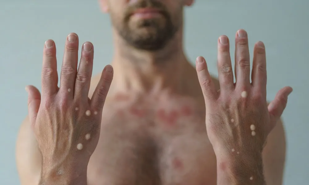 Primeira confirmação da nova cepa da mpox no Brasil acende alerta, mas especialistas descartam pânico