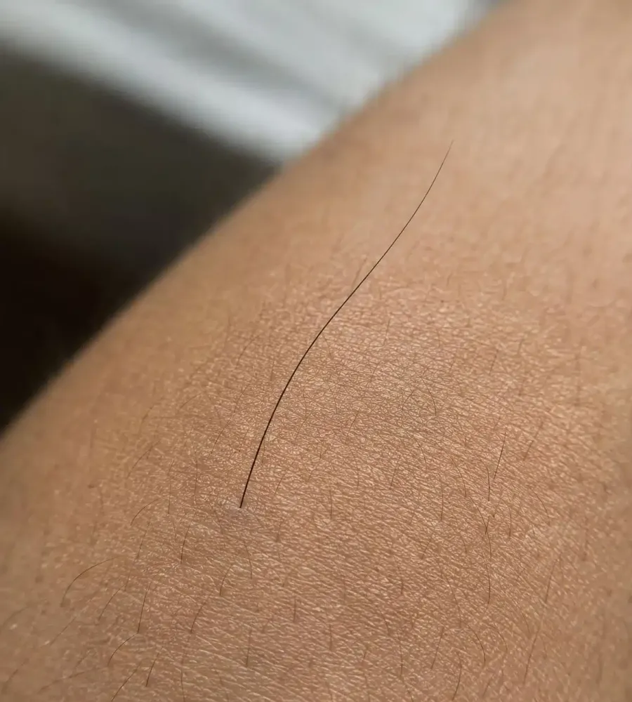 O mistério do pelo solitário: por que um fio comprido surge “do nada” no corpo?